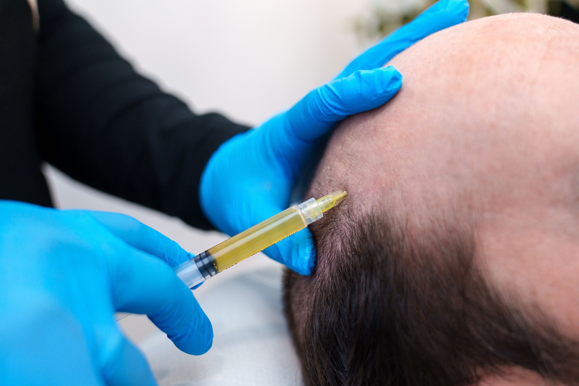 Precision PRP Injection Technique for Scalp Hair Regrowth Therapy